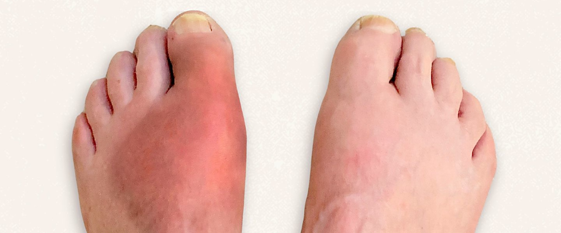 Expert Tips for Treating and Preventing Common Foot Disorders