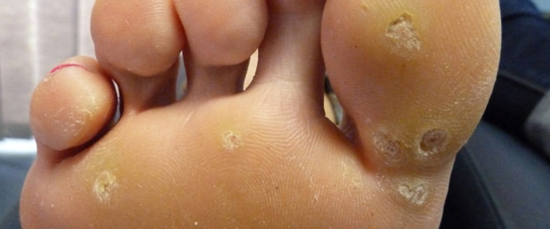 Expert Insights: The Most Common Foot Problems and How to Treat Them