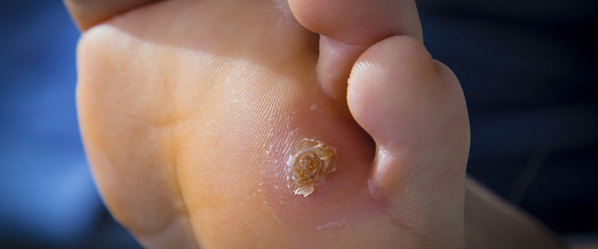 Expert Tips for Treating Common Foot Problems