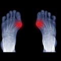 Bunion Surgery: Podiatrist vs Orthopedic Surgeon