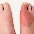 Expert Tips for Treating and Preventing Common Foot Disorders