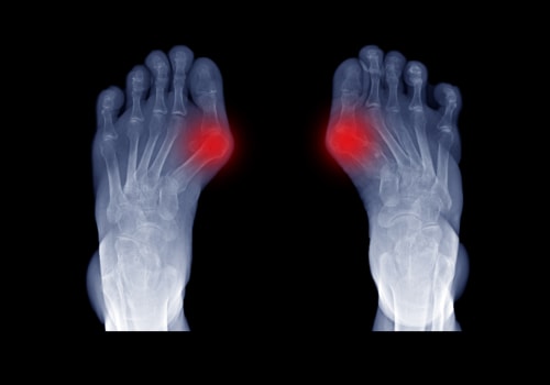 Bunion Surgery: Podiatrist vs Orthopedic Surgeon