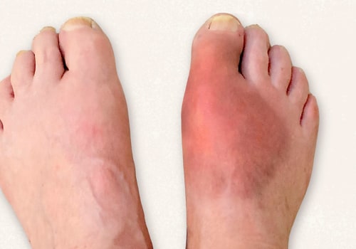 Expert Tips for Treating and Preventing Common Foot Disorders